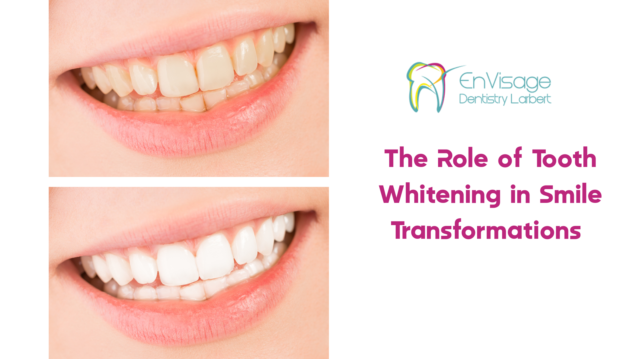 The Role of Tooth Whitening in Smile Transformations The Role of Tooth Whitening in Smile Transformations